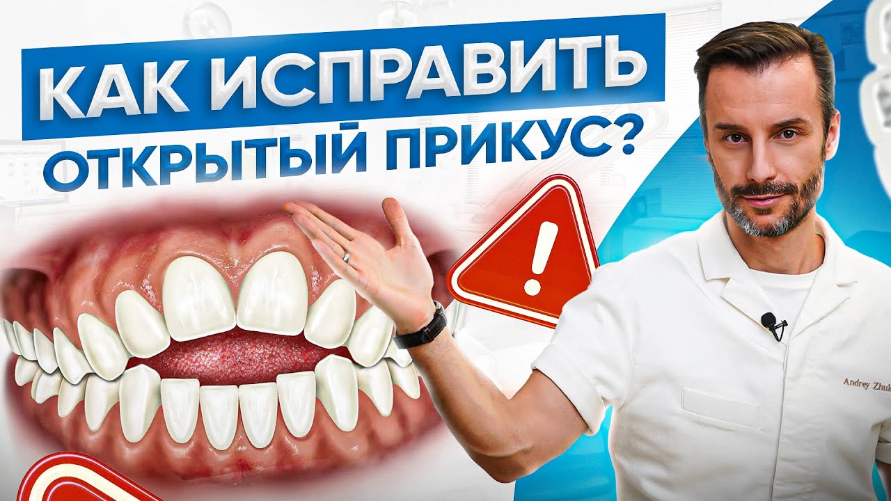 Открытый прикус ДО и ПОСЛЕ. Причины, последствия и лечение открытого прикуса
