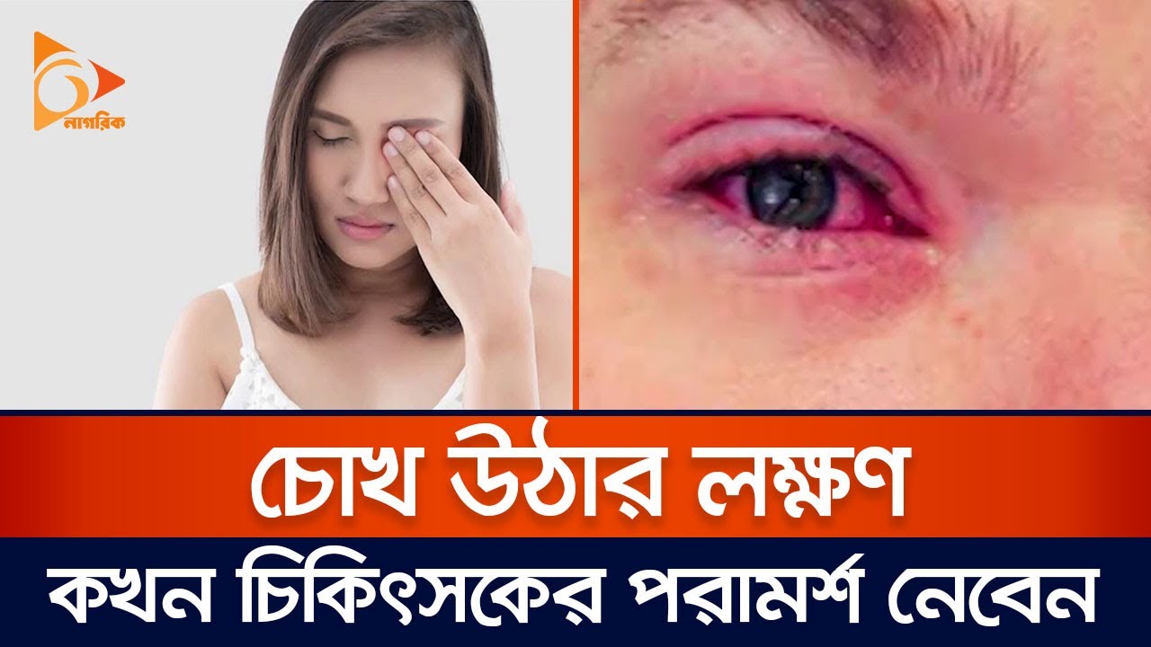 চোখ উঠার লক্ষণ কখন চিকিৎসকের পরামর্শ নেবেন | Eye | Doctor | Nagorik TV