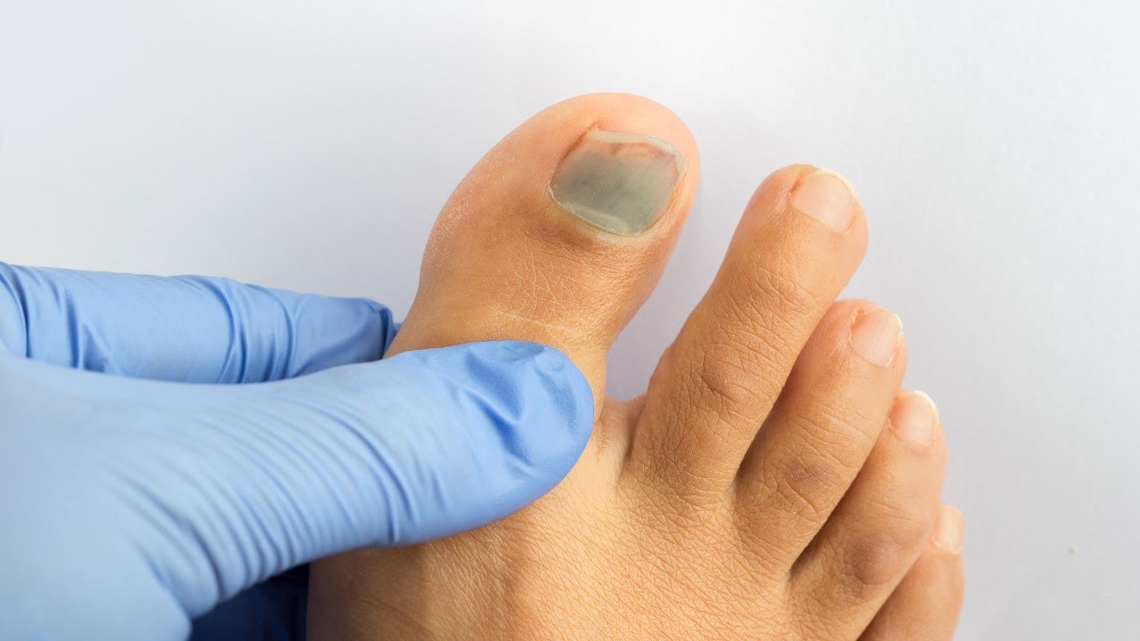 All About Health - Subungual Hematoma (大愛醫生館 - 超痛的出血)