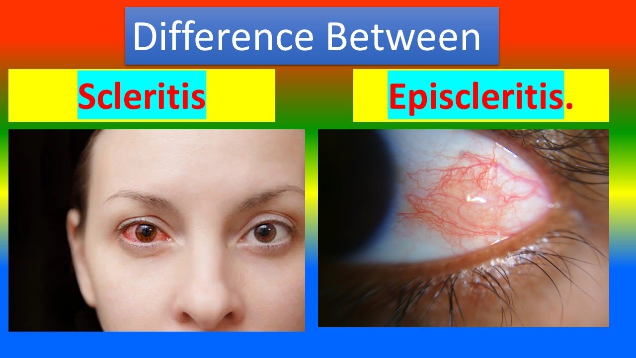 Difference between Scleritis and Episcleritis