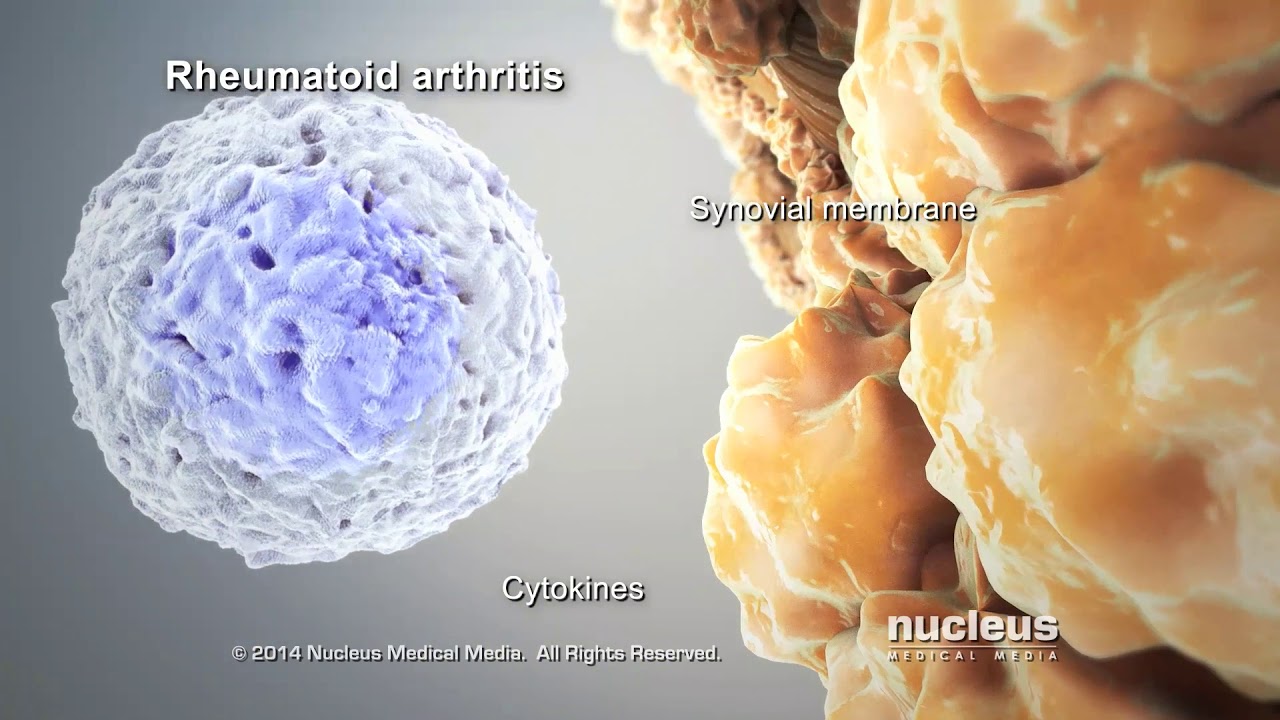 Rheumatoid Arthritis Animation - Cook Children's
