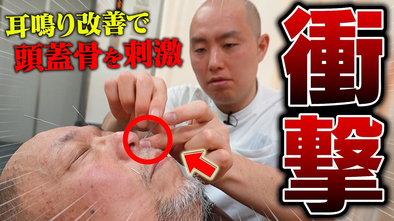 【根深い耳鳴り&hellip;】極太鍼で頭蓋骨を刺激した結果&hellip;