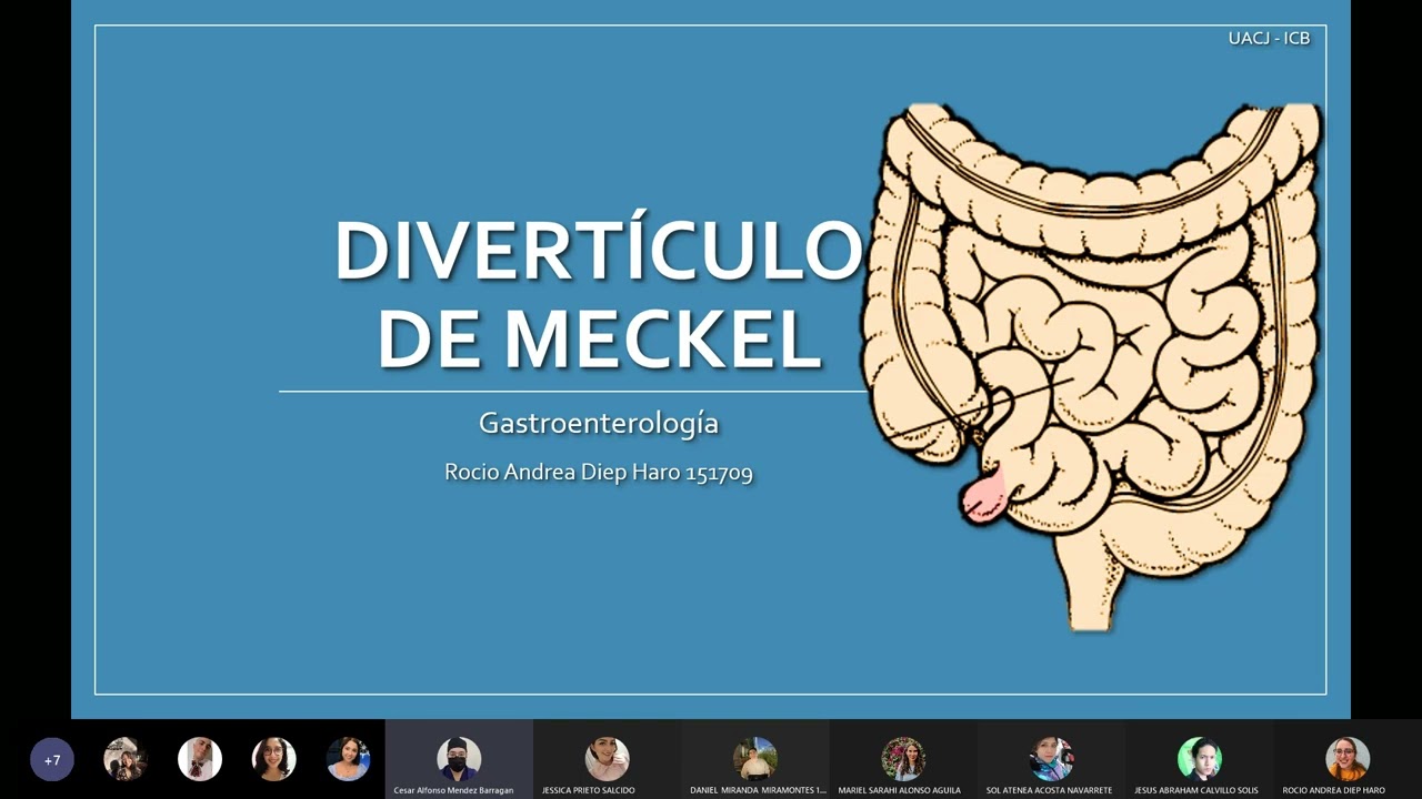 DIVERTICULO DE MECKEL