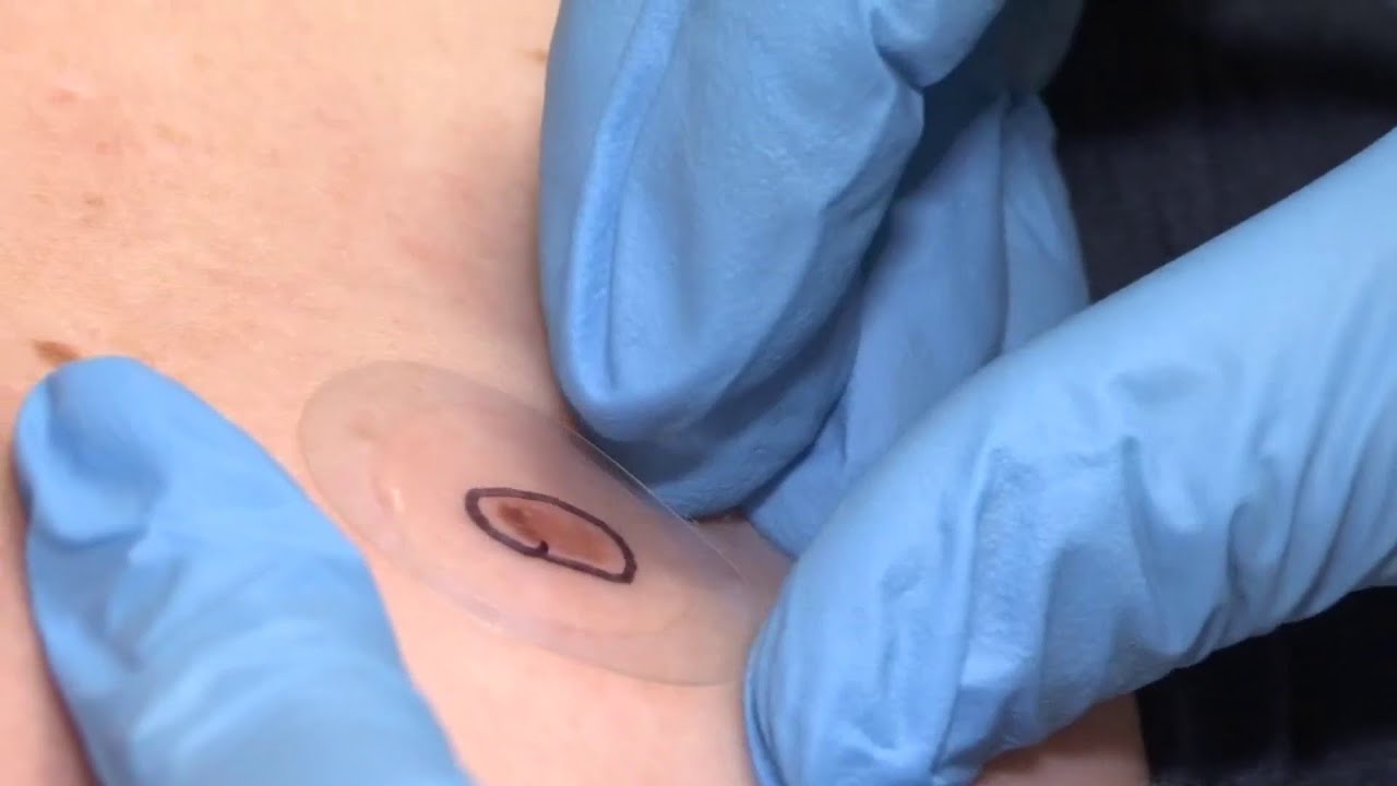 Melanoma Detection: New sticker test predicts cancer diagnosis