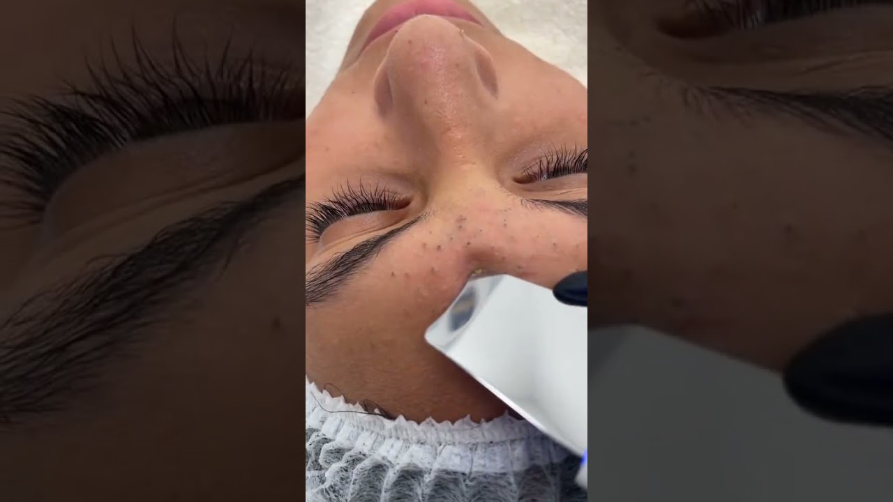 ACNE  SEVERE SUR LE FRONT ET EXTRACTION DIFFICILE #acne  #acnetreatment  #sant&eacute;  #boutons  #femme