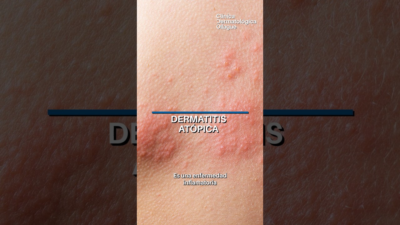 Dermatitis atopica 