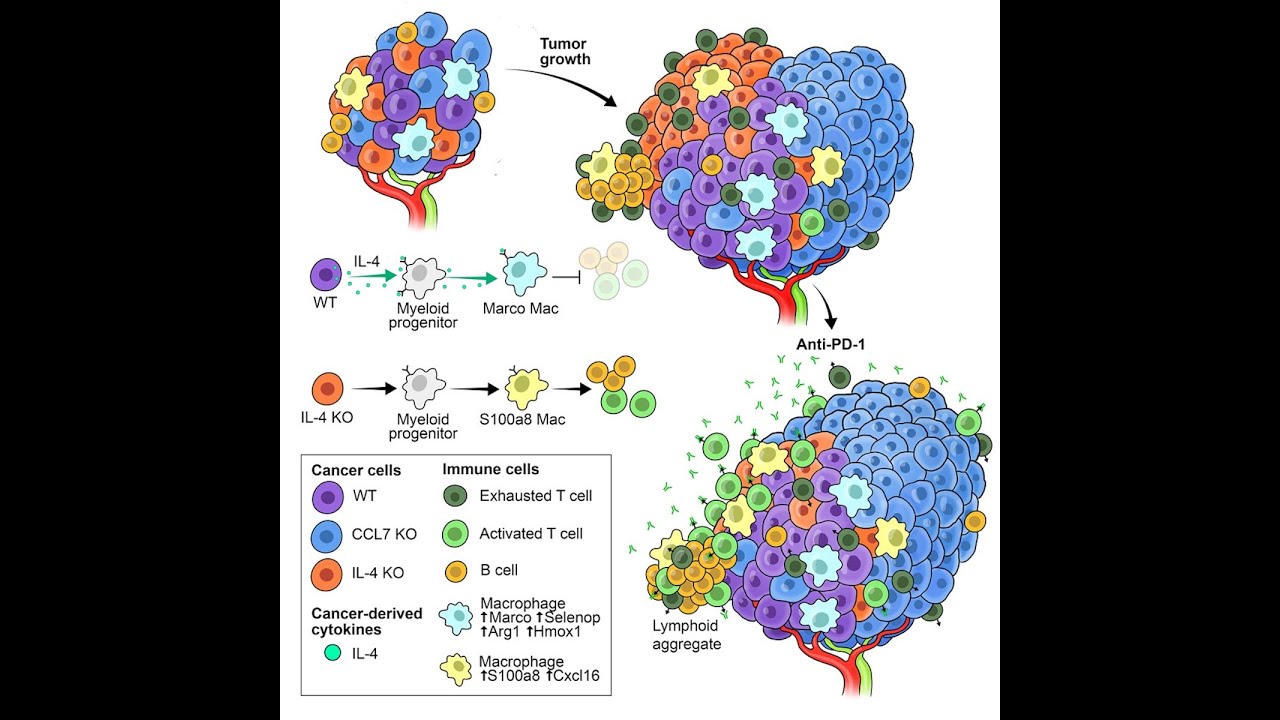 Breakthrough in Ovarian Cancer: Blocking IL-4 to Overcome Immunotherapy Resistance