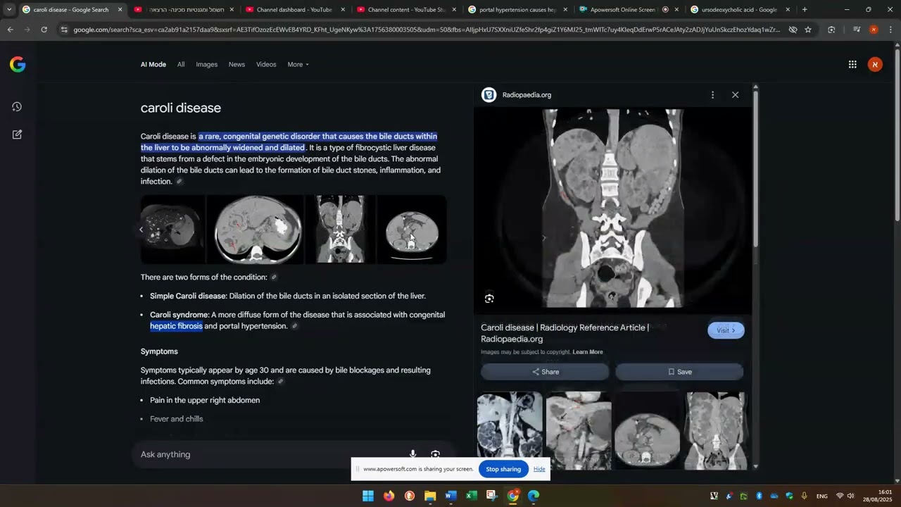 Radiology and Surgery   Caroli disease and Caroli syndrome