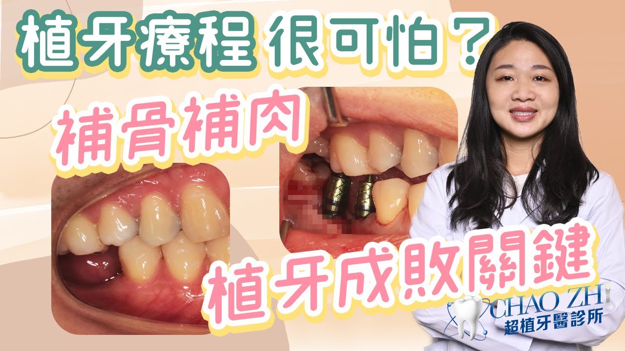 對於植牙手術大家了解多少呢？｜台中牙科陳怡蓉醫師小學堂EP.6 為什麼會有那麼多缺牙的人感到害怕呢？ 或許聽完陳怡蓉醫師解說植牙手術，會讓你對植牙不安全感消除許多唷！#植牙手術 #台中植牙推薦