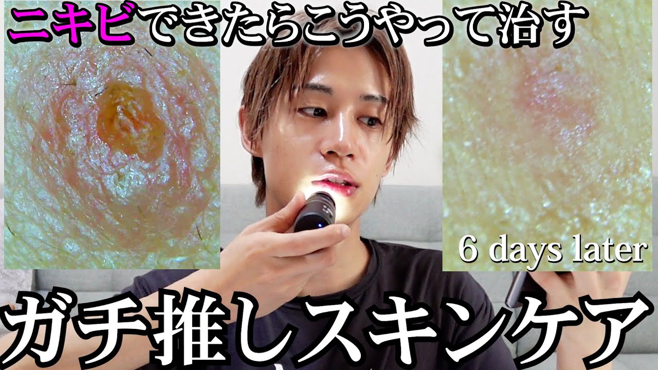 【メガ割前必見！】ニキビ肌から美白肌になるスキンケア方法。