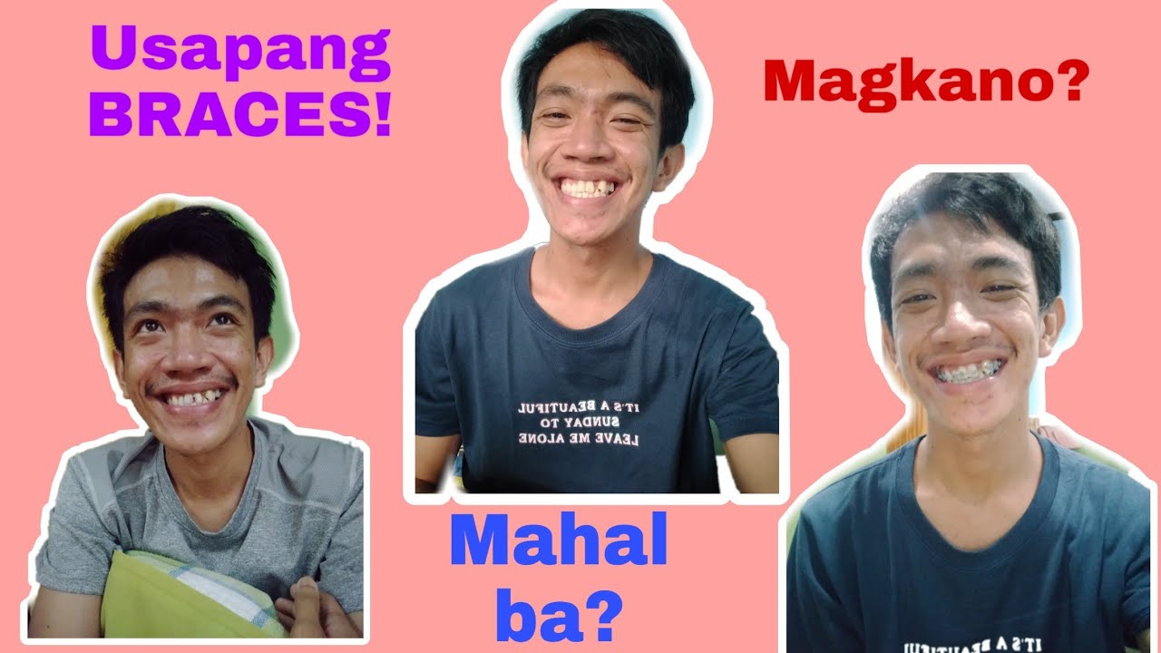 Usapang Braces: My journey on getting my braces. Mahal ba? Masakit ba?