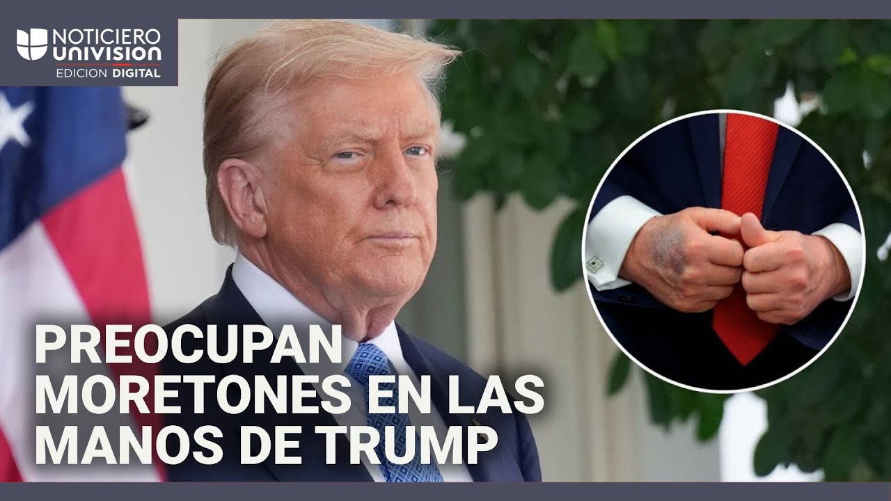 ¿Por qué Trump tiene moretones en las manos? Un médico explica la condición que afecta al presidente