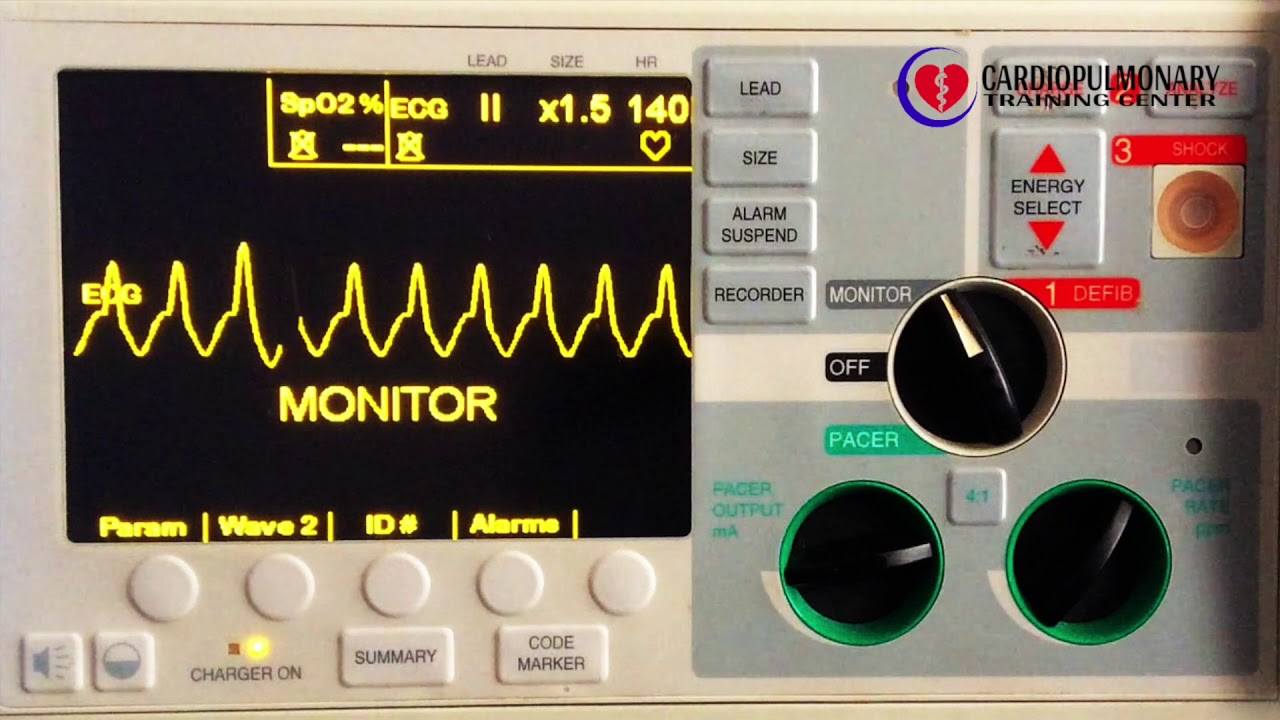 Taquicardia Ventricular