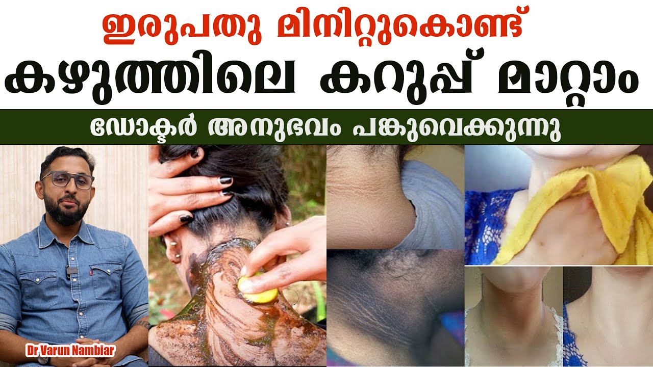 ഇരുപതു മിനിറ്റുകൊണ്ട്  കഴുത്തിലെ കറുപ്പ് മാറ്റാം .ഡോക്ടർ അനുഭവം പങ്കുവെക്കുന്നു  /Dr Varun Nambiar