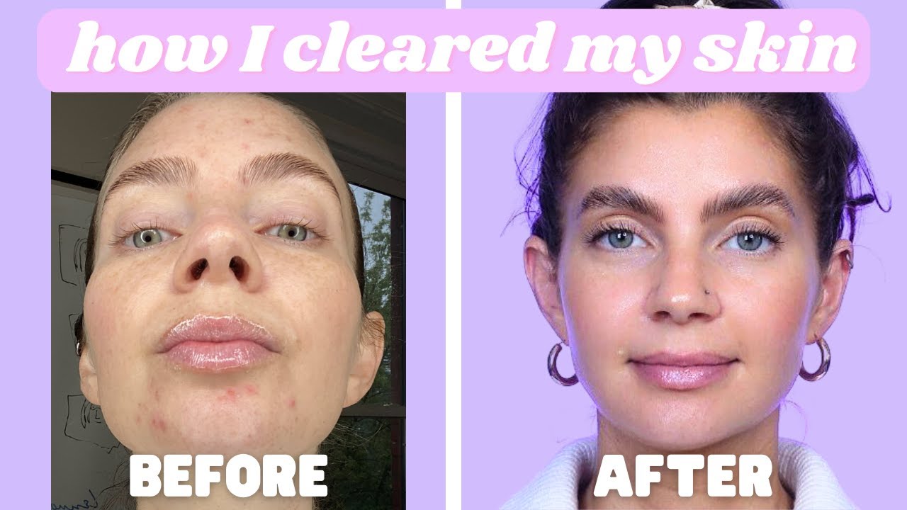 How I cleared my acne FOR GOOD - spironolactone experience, whole journey