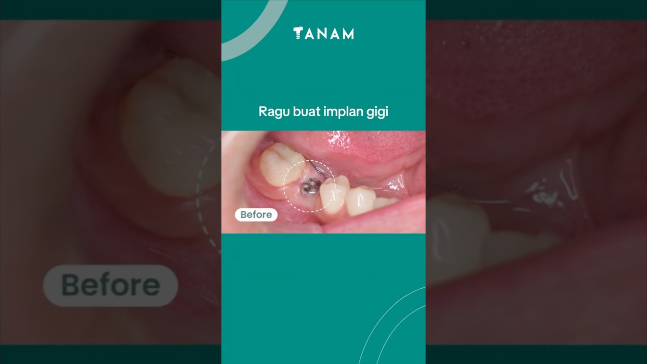 Jadi masih ragu buat implan gigi?😌 implan di TANAM aja!🥰 