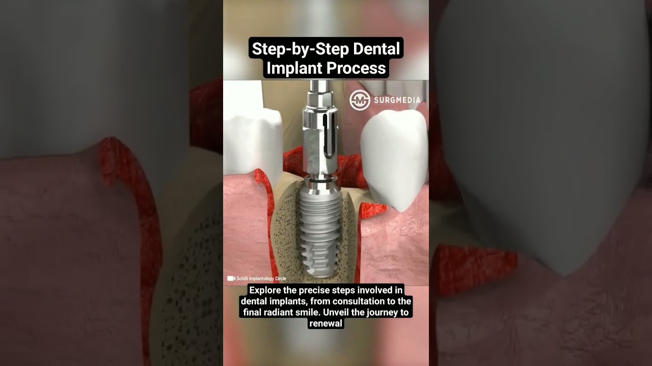 Step-by-Step Dental Implant Process #DentalImplants #OralSurgery #DentalCare #SmileRestoration