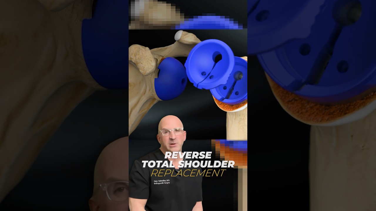 Shoulder Replacement Surgery: What You NEED To Know