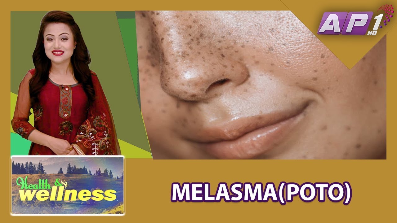 MELASMA (POTO)  || PREVENTION AND TREATMENT || HEALTH AND WELLNESS