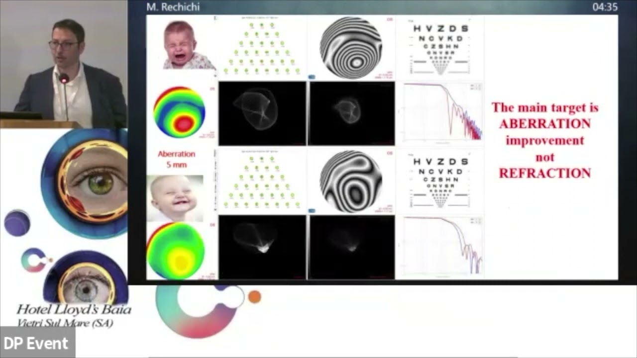 Cheratocono ed aberrazioni: uso del laser ad eccimeri per migliorare la qualit&agrave; visiva - M. Rechichi