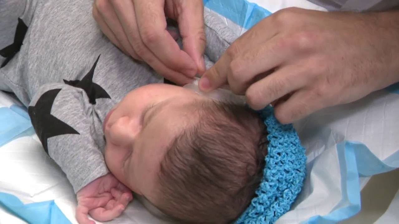 Ear molds help contour babies' ears into more natural shape