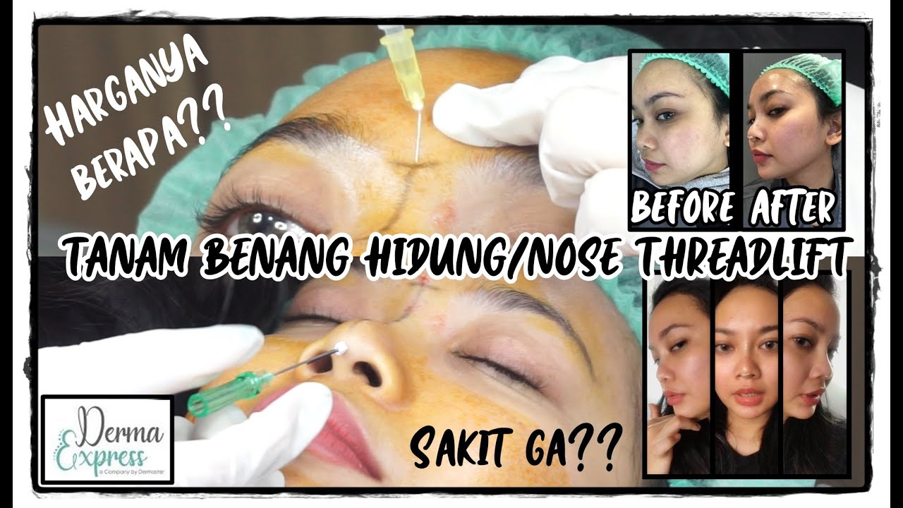 TANAM BENANG HIDUNG / NOSE THREADLIFT || DERMA EXPRESS JAKARTA - UTAN KAYU