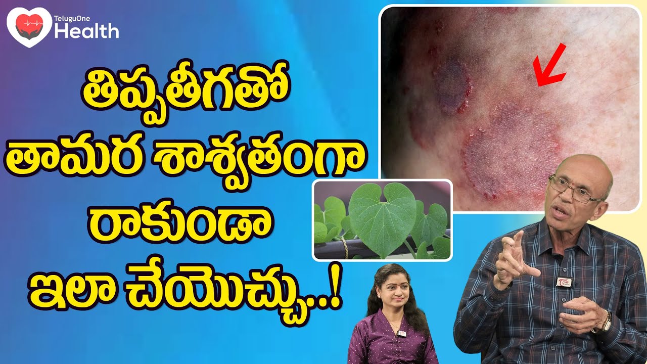Tamara Remedy | తిప్పతీగతో తామర శాశ్వతంగా రాకుండా ఇలా చేయొచ్చు Dr. Ch Madhusudana Sarma | ToneHealth