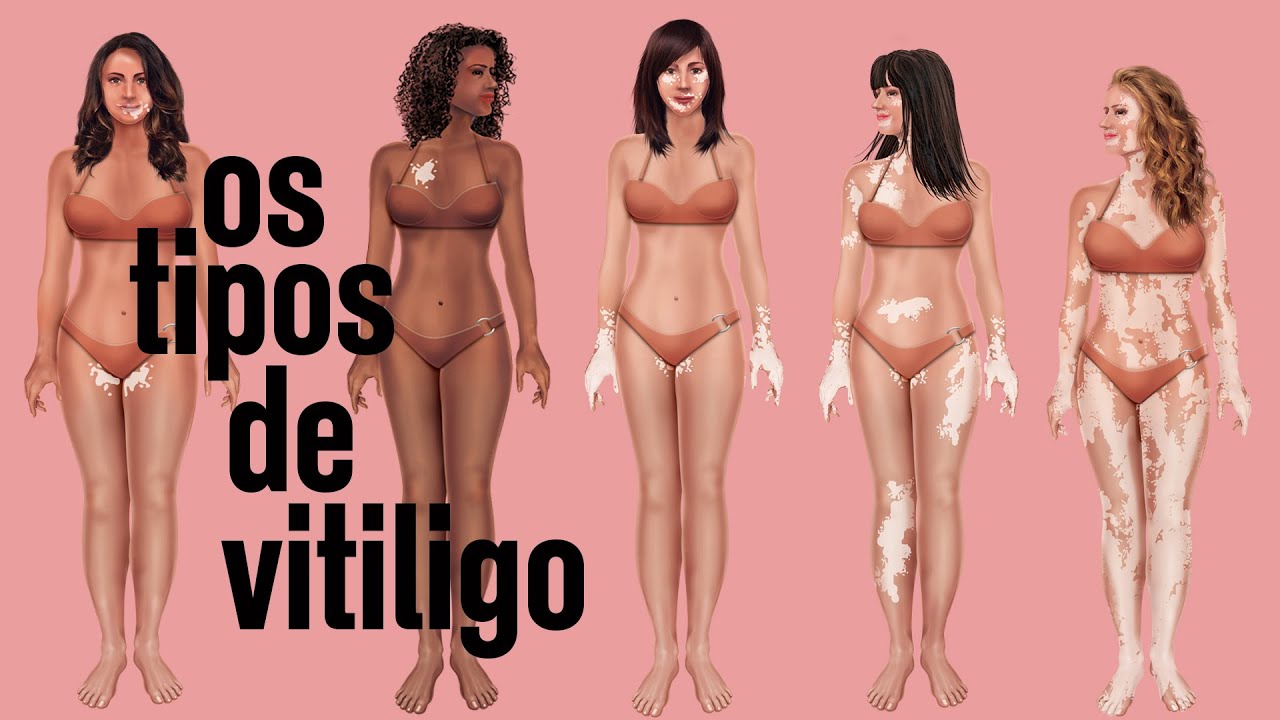 Os tipos de vitiligo que existem