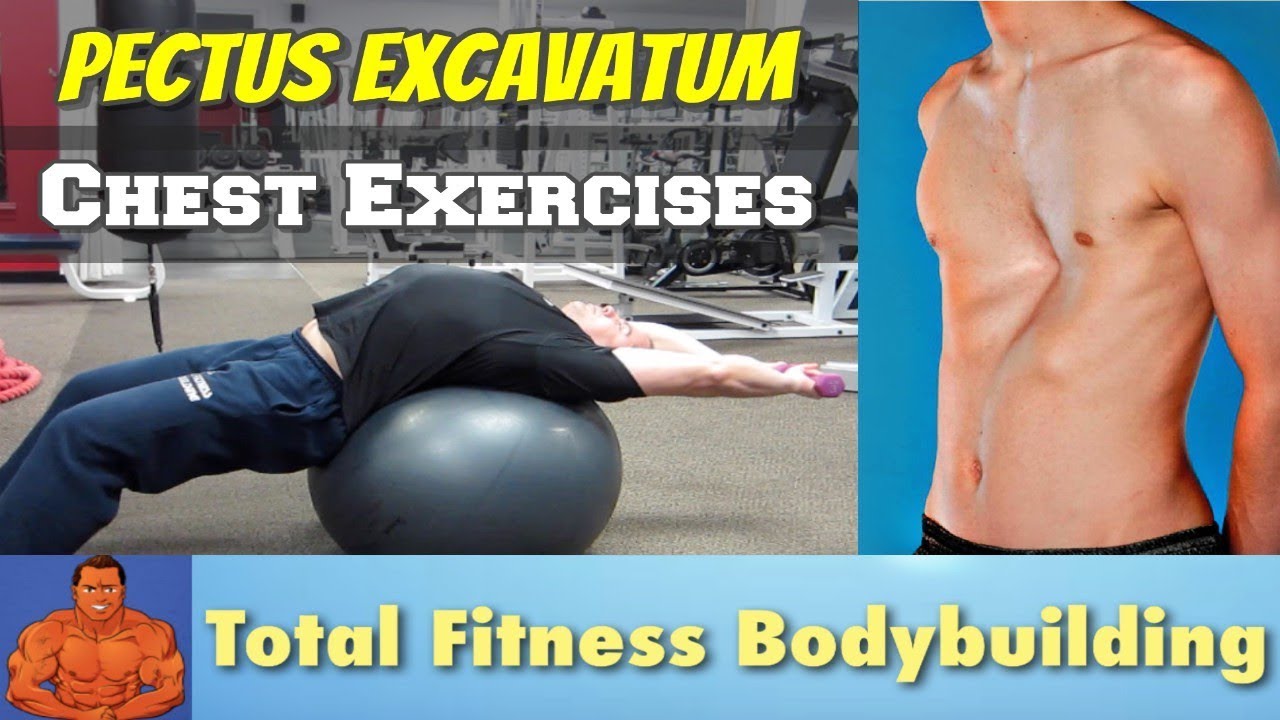 Chest Stretching Exercises for Pectus Excavatum (sunken chest)