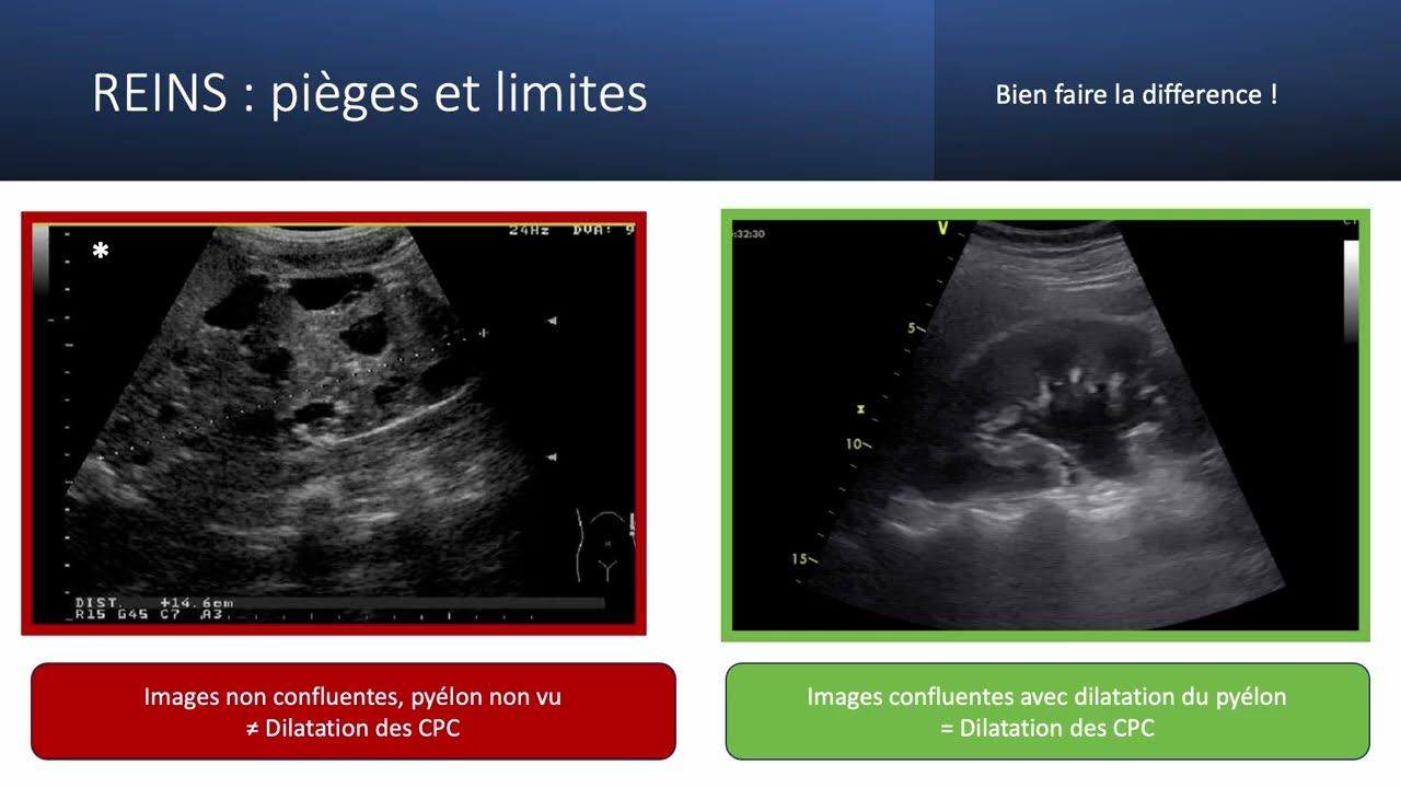ECMU - Echographie abdominale