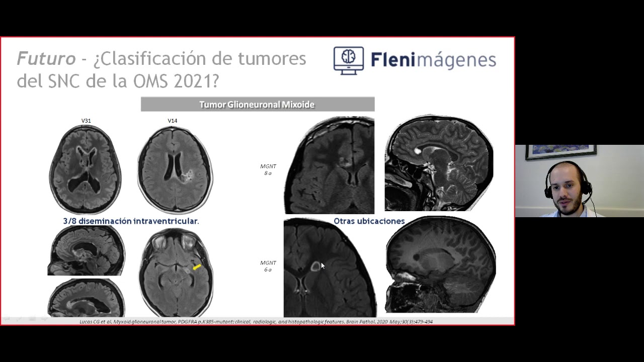 Webinar Neurooncologia: Imágenes en Tumores Glioneuronales del SNC