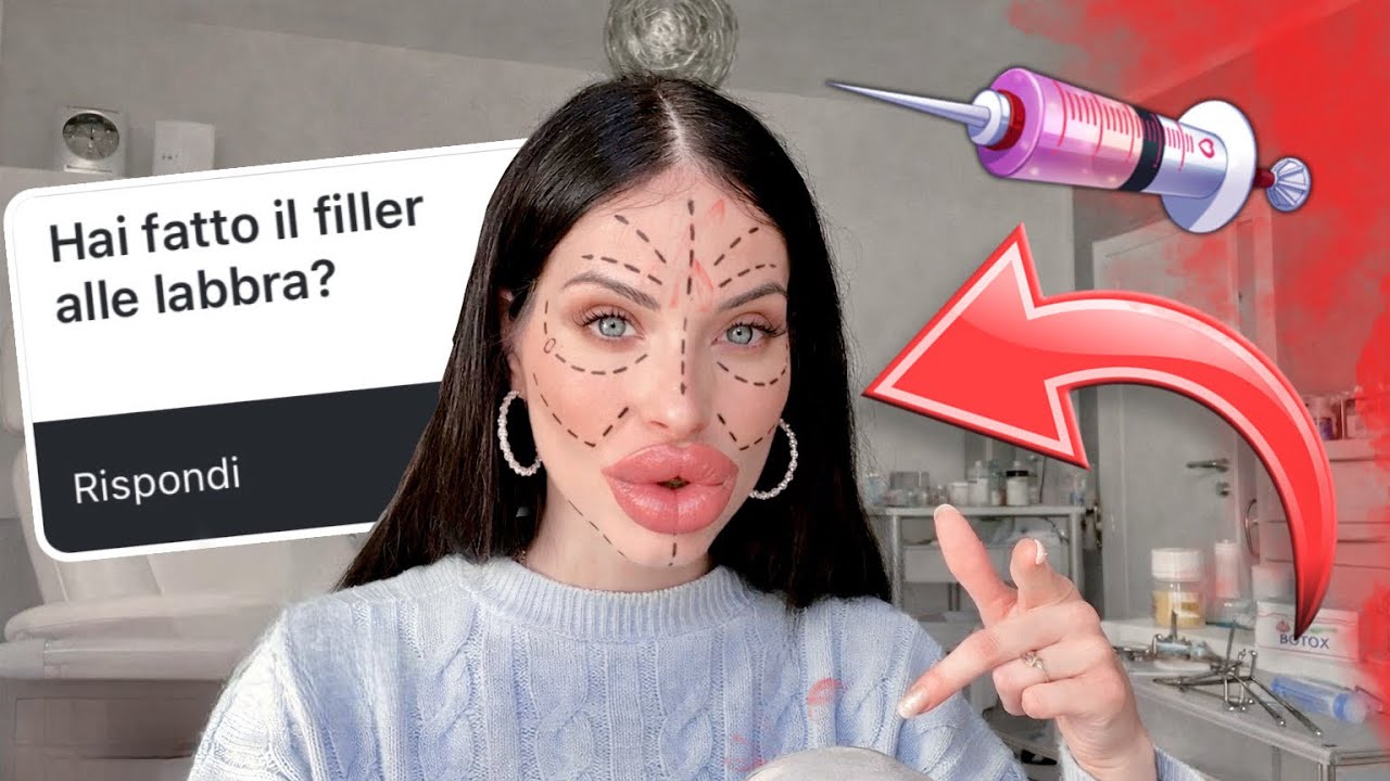 Q&A HAI FATTO IL FILLER LABBRA? 