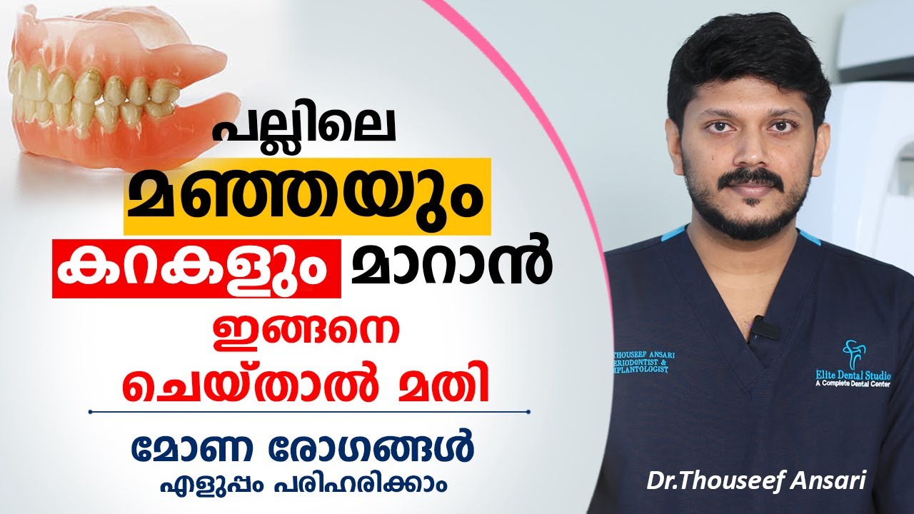 പല്ലിലെ കറകളും മഞ്ഞയും മാറാൻ ഇങ്ങനെ ചെയ്താൽ മതി | Dr.Thouseef Ansari | Oral Health