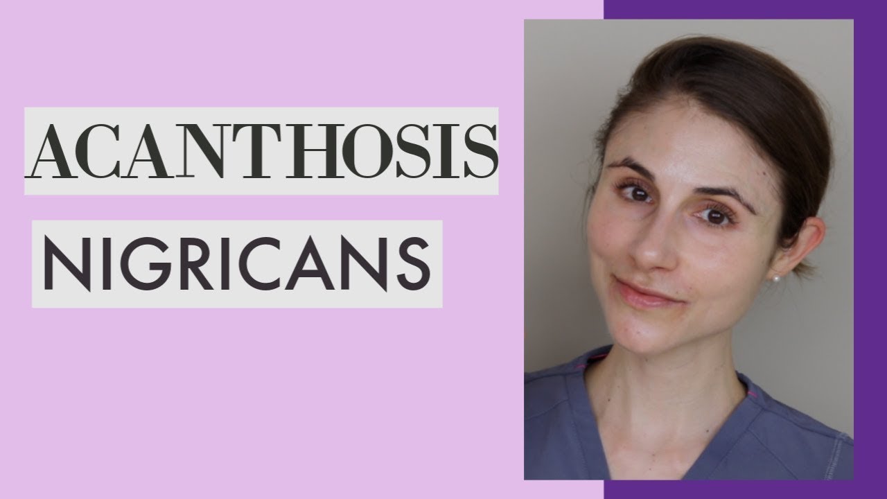 ACANTHOSIS NIGRICANS: Q&A WITH DERMATOLOGIST DR DRAY