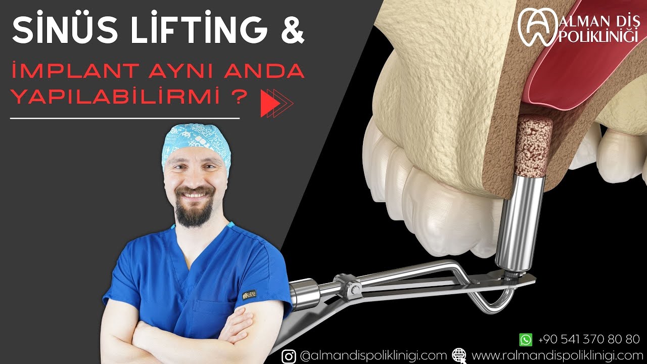 Sinüs Lifting (sinüs kaldırma ) ve İmplant Aynı Anda Yapılabilir mi | Dr. Ali Onur SAYDAM