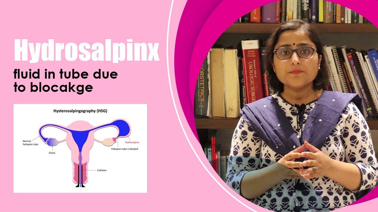hydrosalpinx - what next ? ट्यूब में पानी का भरना