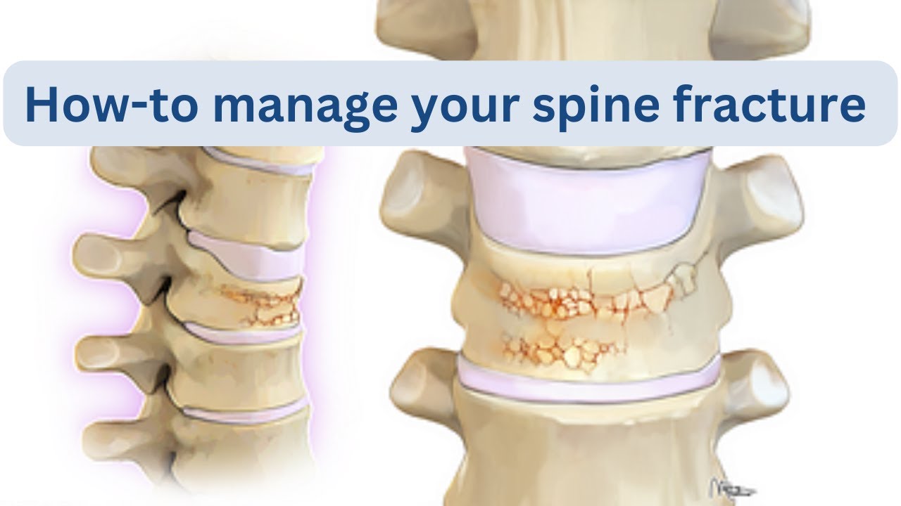 How-to manage your spine fracture