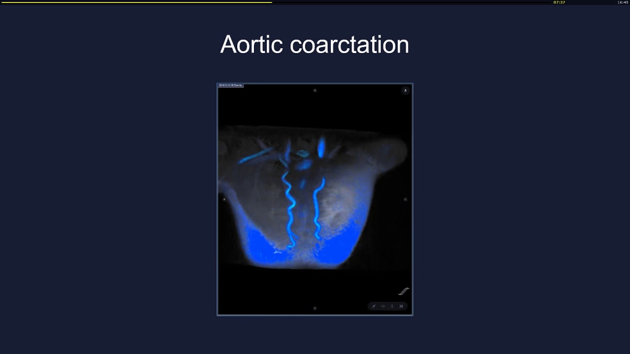 4D Flow MRI - A revolution for Congenital Heart Disease