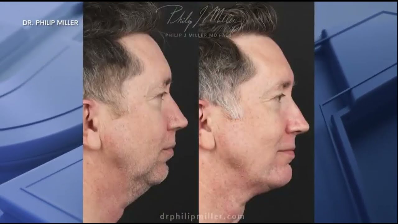 Dr. Philip Miller Talks About Male Facelift on Fox5 NY