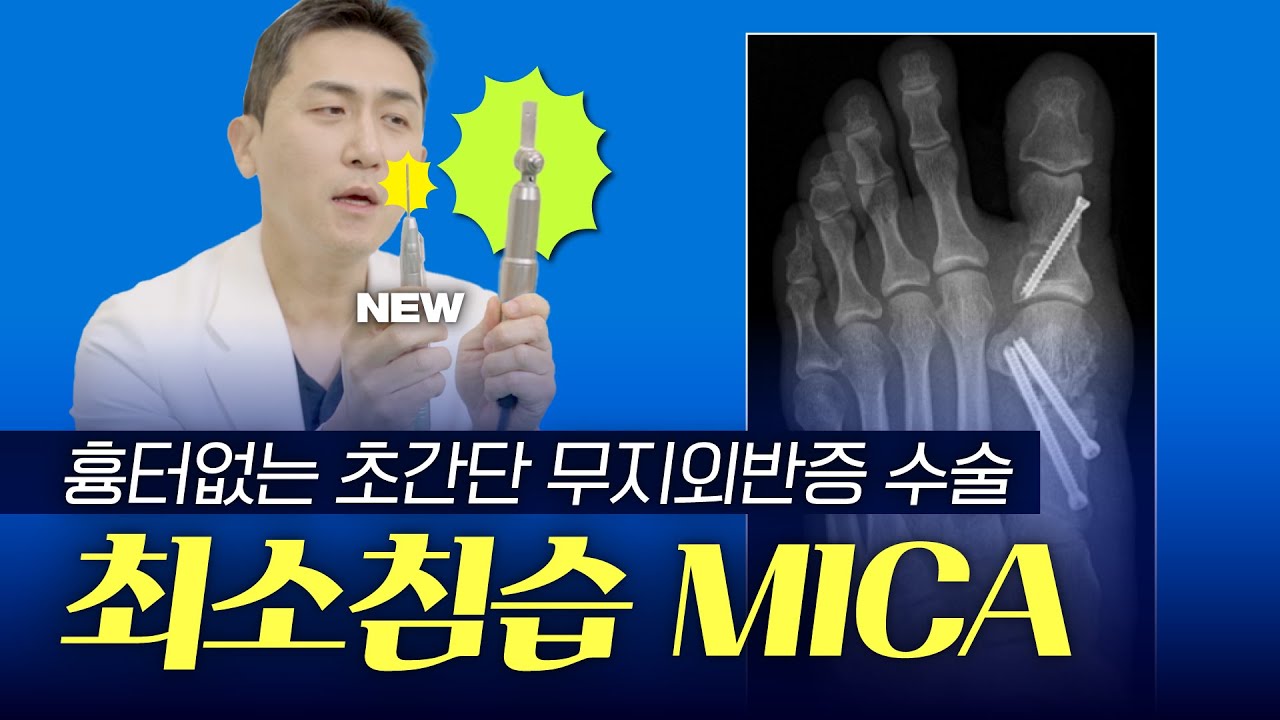 무지외반증 교정 최소침습 MICA수술 고민중이시라면 꼭 보세요! ㅣ기존절개수술 VS 미카ㅣ210정형외과 최준하 대표원장