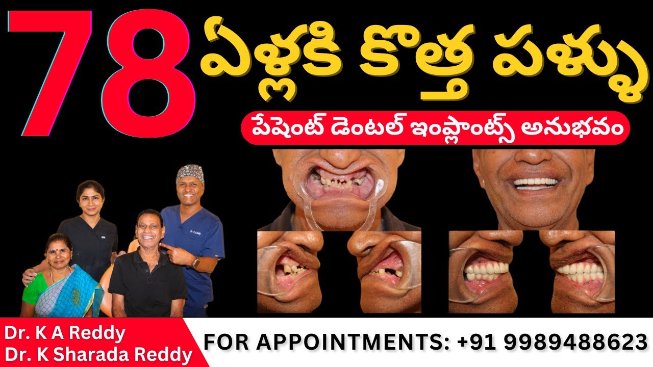 78 ఏళ్ల పేషెంట్ కి 7 రోజుల్లో Permanent పళ్ళు | Dental Implants Before & After Review Telugu