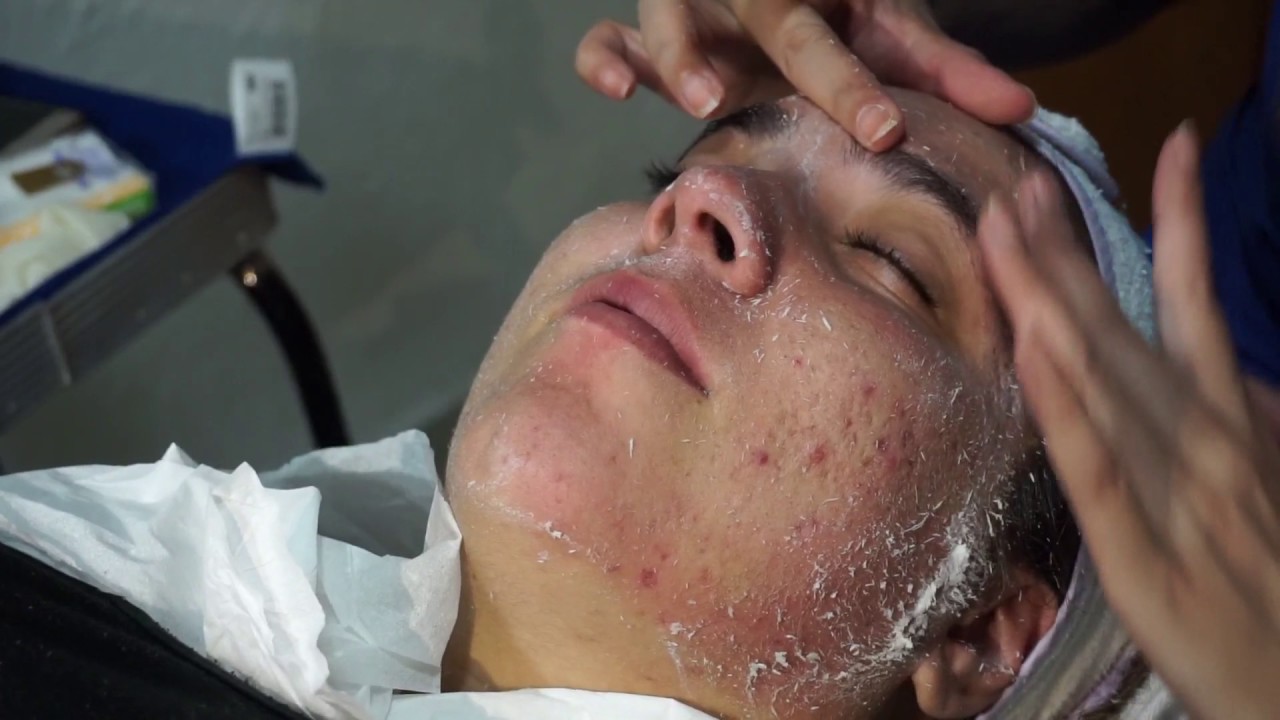 Tratamiento cicatrices de acne