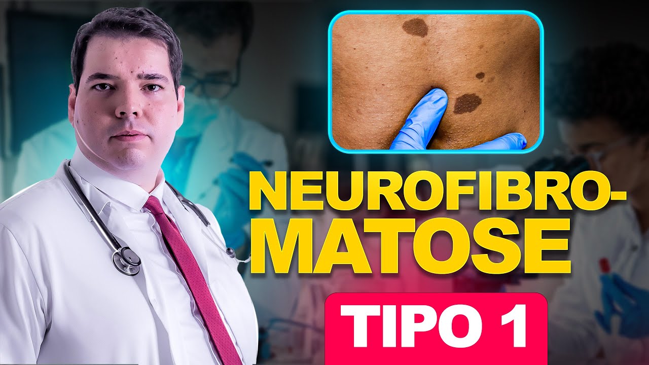 Neurofibromatose tipo 1 - Manchas Café Com Leite