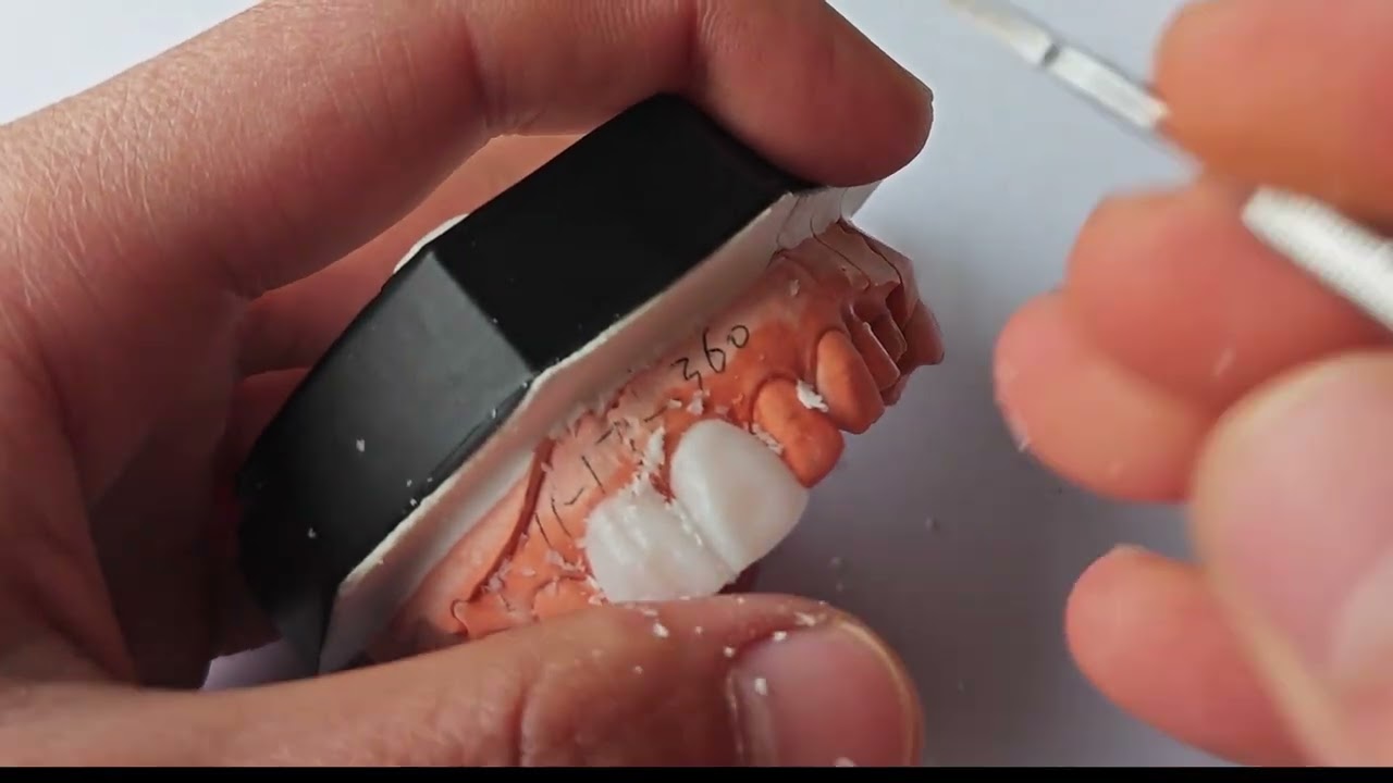 Live  Wax  Up—maxillary central incisors(full)