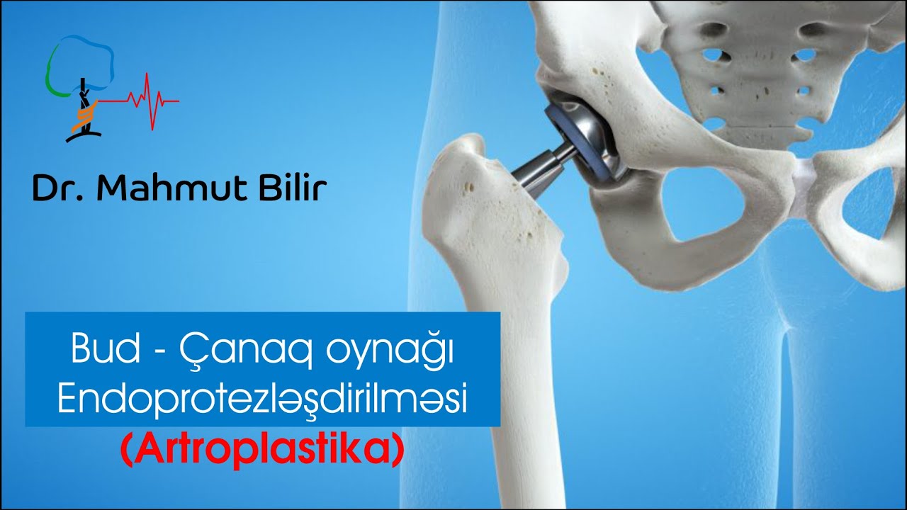 Bud - Çanaq oynağı Endoprotezləşdirilməsi (Artroplastika)