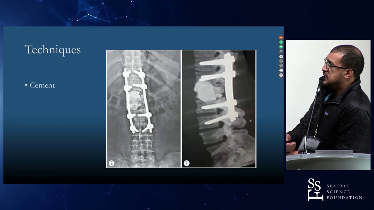 The Role of Anterior Column Reconstruction in Spine Surgery - Amir Abdul Jabbar, MD
