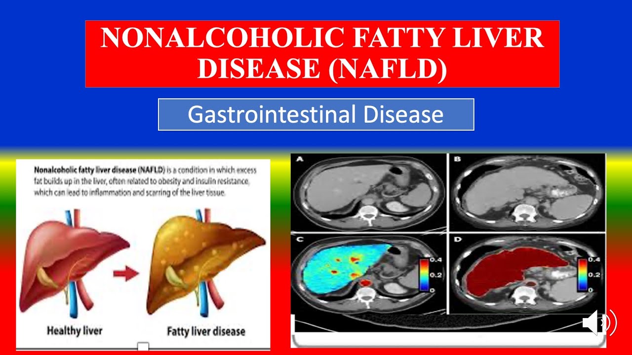 NICHTALKOHOLISCHE FETTLEBERERKRANKUNG (NAFLD) &ndash; Arten, Ursachen, Pathophysiologie, Diagnosen, Med...