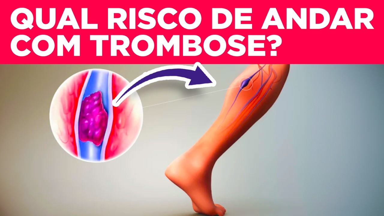 TROMBOSE precisa mesmo de repouso ou dá embolia pisar no chão? Pode trabalhar ou caminhar? Riscos?