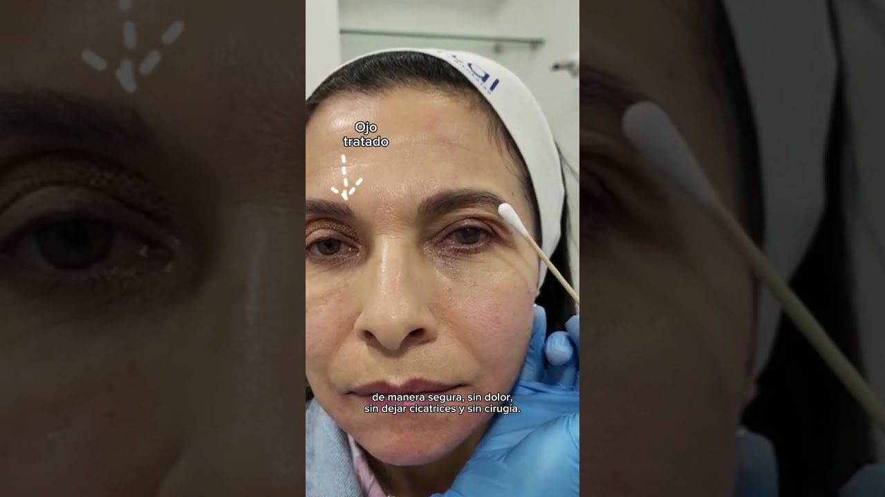 Blefaroplastia Sin Cirugía - Dr. Angélica Domínguez Dermatóloga en bogotá