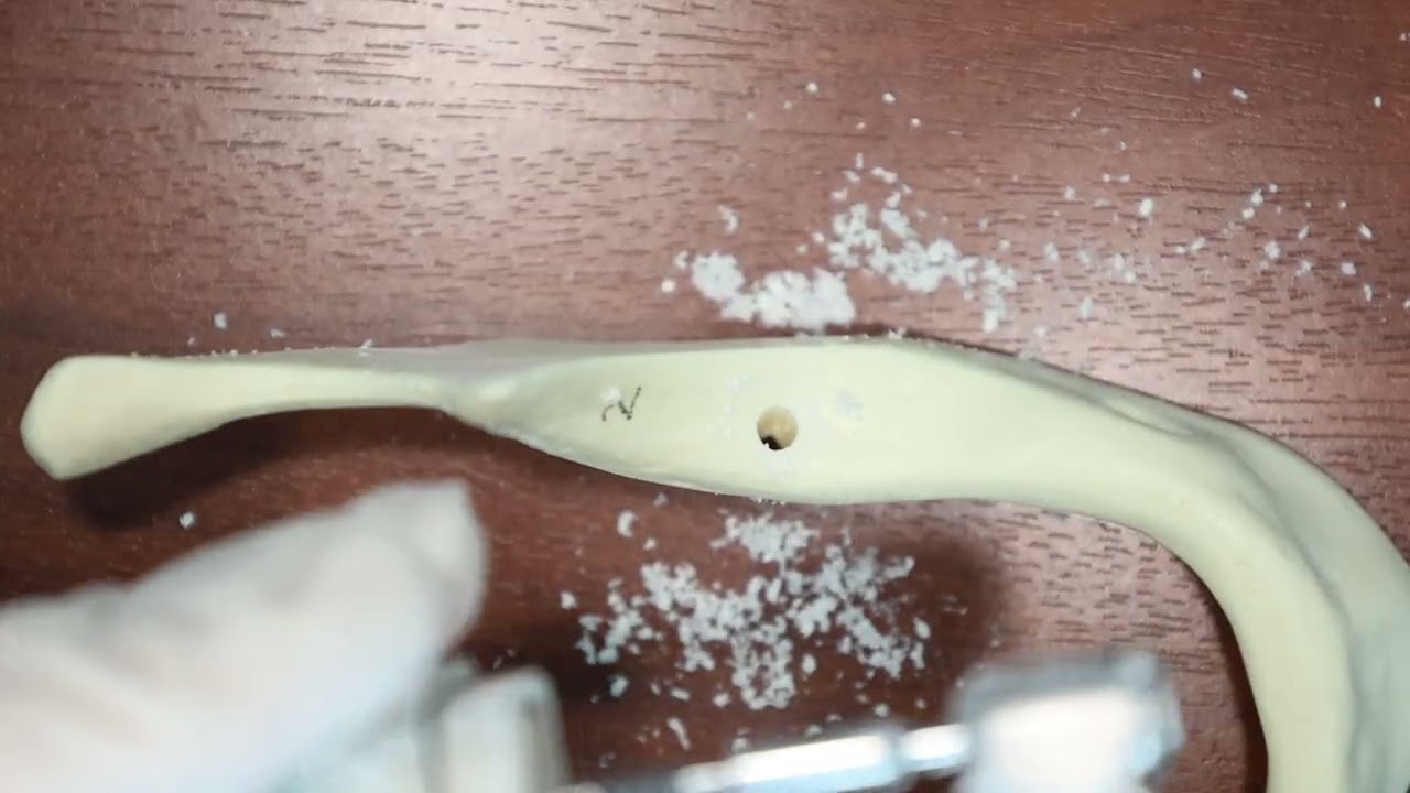 Monoimplant Placement Demo (Mandibular Posterior Bicortical Stabilisation/Nerve Passing By Medially)